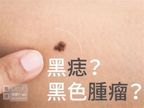 手臂有黑痣|不大驚小怪！如何辨別「黑痣」與「黑色腫瘤」？ 